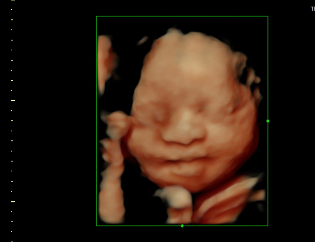 3D ultrasound image at 29 weeks